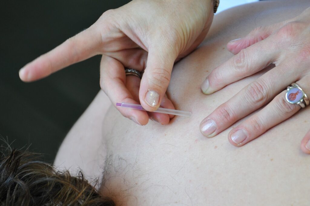 Dry needling